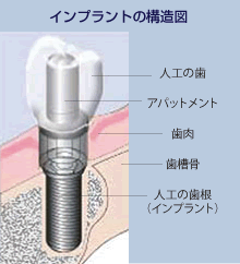 インプラント図解