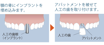 インプラント図解