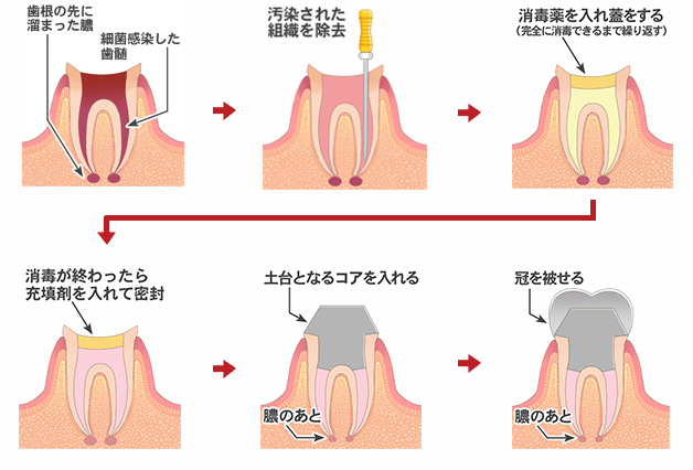 根の治療（根管治療）