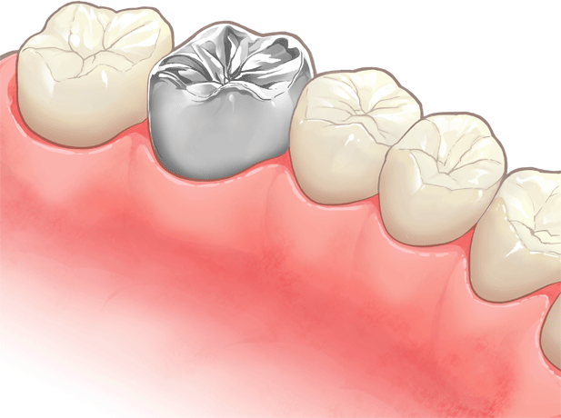 金属冠(銀歯)