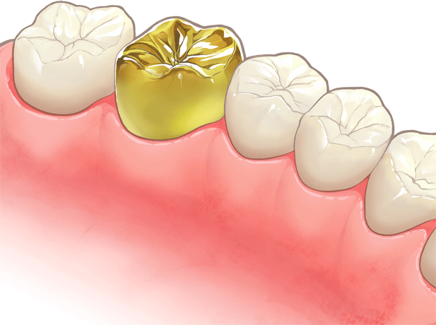 ゴールドクラウン(金の被せ物)
