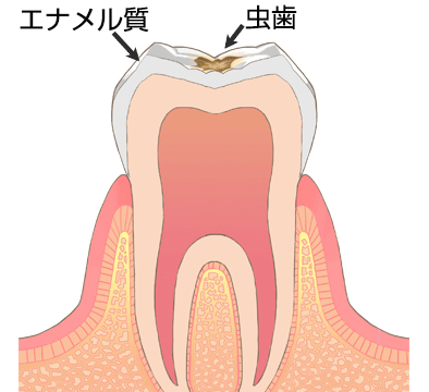 虫歯・う蝕の進行