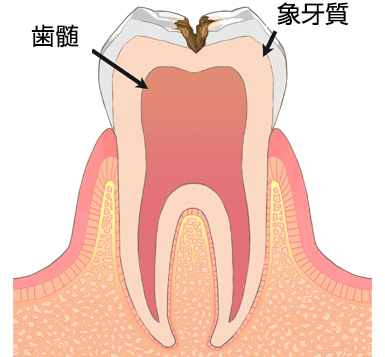 虫歯・う蝕の進行