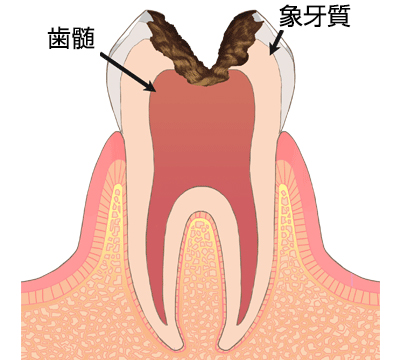 虫歯・う蝕の進行