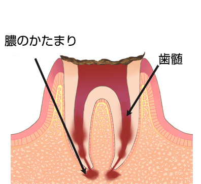 虫歯・う蝕の進行